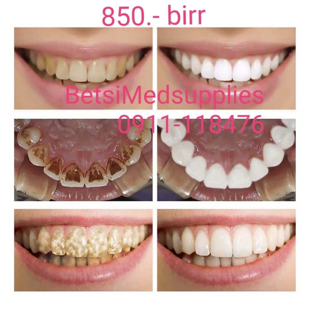 Lanbena – Teeth whitening. ለበለዘና ለጠቆረ ጥርስ ንጣትና ውበት